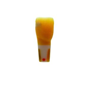 Meiteeth 11, mesial proximal caries and distortion