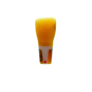 Meiteeth 21 mesial class ||| GIC filling