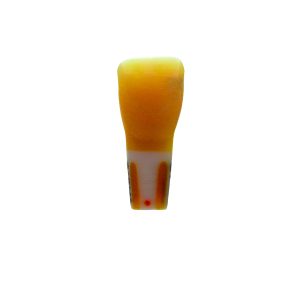 Meiteeth 21 with full anatomical caries defect